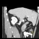 Angiomyolipoma of kidney: CT - Computed tomography